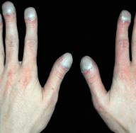 Заболевания ногтей на руках: диагностика и лечение О каких заболеваниях говорят ногти